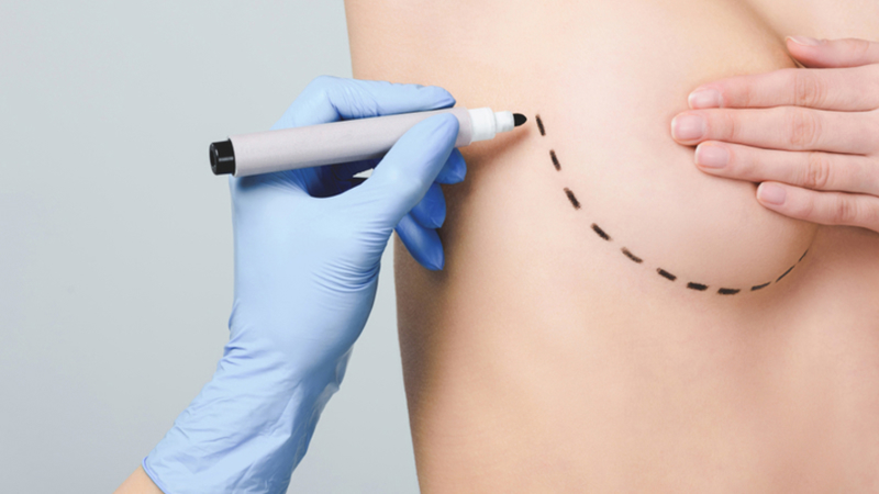 Sketch Plastic Surgery breast